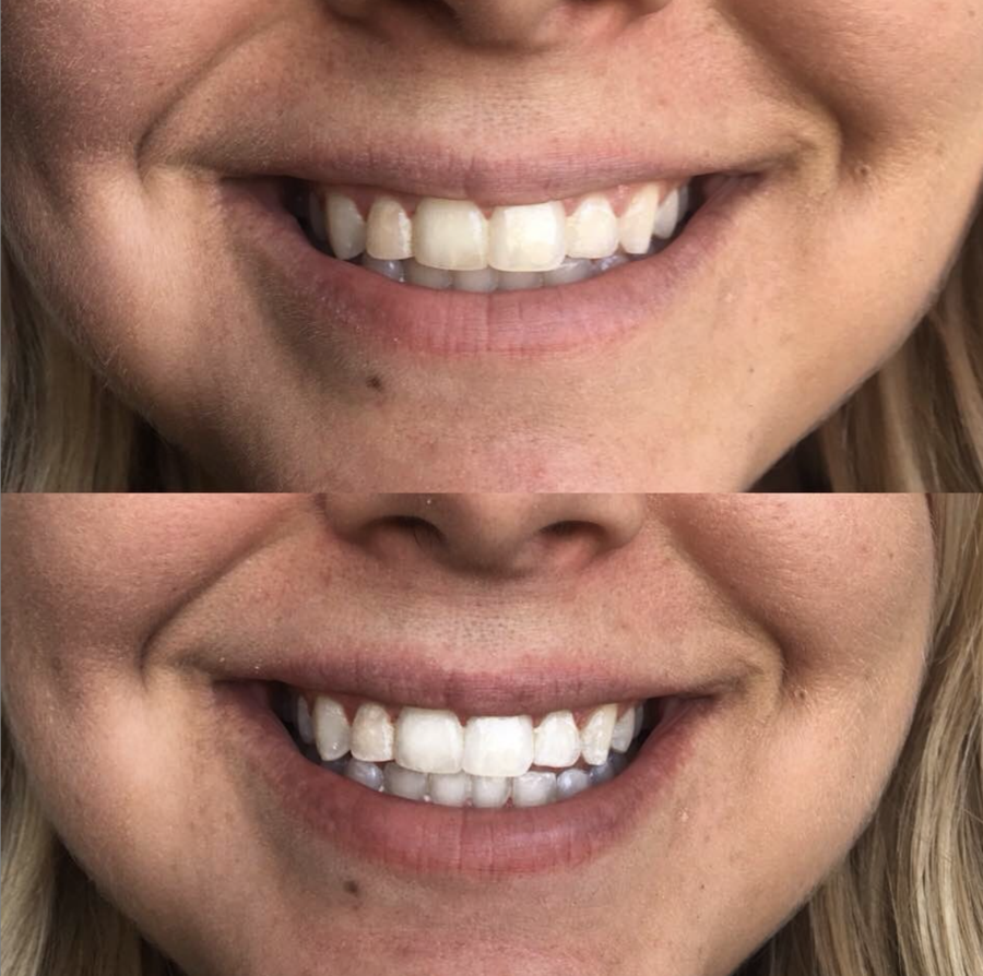 beaut. TEETH WHITENING KIT